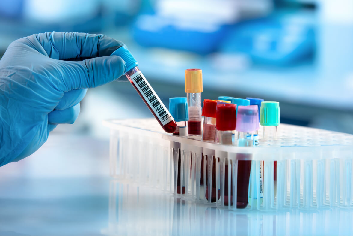آزمایش های خون و ادرار؛ چرا باید انجام دهیم؟